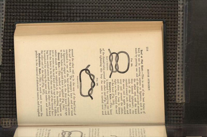 FIG. 194. Reef or Flat Knot.—This is one of the best forms of knot to use in securing sutures or ligatures, and it is made by passing one end of the thread over and around the other end, and the knot thus formed tightened ; the ends of the thread are next carried toward each other and the same end is again carried over and around the other, and when the loop is drawn tight we have formed the reef or flat knot (Fig. 194). Surgeon's Knot.—This knot is formed by carrying one end of the thread twice around the other end (Fig. 195); and after tightening this loop the same is carried over and FIG. 195. Reef or flat knot. Surgeon's knot. around the other end as in the case of the final knot of the reef or flat knot. The surgeon's knot and reef knot combined is one of the best methods of securing sutures or ligatures of catgut or silk, as the first knot is not apt to relax before the second knot is applied (Fig. 196). Granny Knot.—This method of tying the ligature or suture should not be employed, as the resulting knot is not as secure as the reef knot and is apt to relax : it differs from the latter in the fact that one end of the thread hav- ing been carried across and around the other end, the knot is completed by carrying the same end under and around the other end of the thread (Fig. 197). Staffordshire Knot.—This is much used to secure the pedicle in the removal of abdominal tumors, and is applied