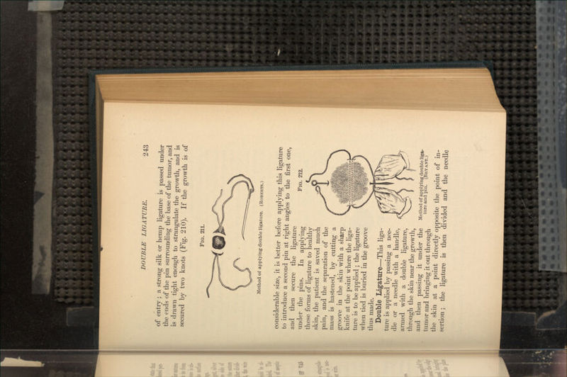 of entry; a strong silk or hemp ligature is passed under the ends of the pin surrounding the base of the tumor, and is drawn tight enough to strangulate the growth, and is secured by two knots (Fig. 210). If the growth is of FIG. 211. Method of applying double ligature. (ROBERTS.) FIG. 212. considerable size, it is better before applying this ligature to introduce a second pin at right angles to the first one, and then secure the ligature under the pins. In applying these forms of ligature to healthy skin, the patient is saved much pain, and the separation of the mass is hastened, by cutting a groove in the skin with a sharp knife at the point where the liga- ture is to be applied ; the ligature when tied is buried in the groove thus made. Double Ligature—This liga- ture is applied by passing a nee- dle or a needle with a handle, armed with a double ligature, through the skin near the growth, and then passing it under the tumor and bringing it out through the skin at a point directly opposite the point of in- sertion ; the ligature is then divided and the needle Method of applying double liga- ture and pin. (BRYANT.)