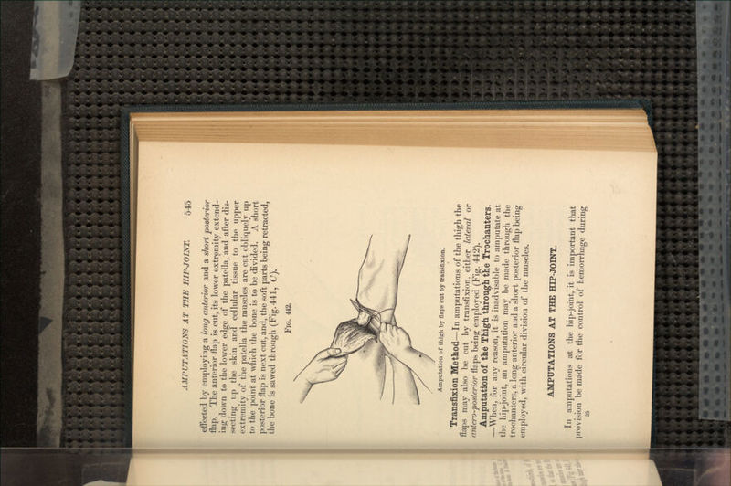 effected by employing a long anterior and a short posterior flap. The anterior flap is cut, its lower extremity extend- ing down to the lower edge of the patella, and after dis- secting up the skin and cellular tissue to the upper extremity of the patella the muscles are cut obliquely up to the point at which the bone is to be divided. A short posterior flap is next cut, and, the soft parts being retracted, the bone is sawed through (Fig. 441, C). Fia. 442. Amputation of thigh by flaps cut by transfixion. Transfixion Method—In amputatio-ns of the thigh the flaps may also be cut by transfixion, either lateral or antero-posterior flaps being employed (Fig. 442). Amputation of the Thigh through the Trochanters. —When, for any reason, it is inadvisable to amputate at the hip-joint, an amputation may be made through the trochanters, a long anterior and a short posterior flap being employed, with circular division of the muscles. AMPUTATIONS AT THE HIP-JOINT. In amputations at the hip-joint, it is important that provision be made for the control of hemorrhage during 35