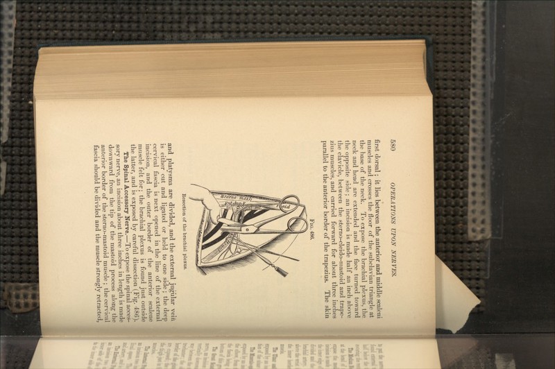 first dorsal; it lies between the anterior and middle scaleni muscles and crosses the floor of the subclavian triangle at the base of the neck. To expose the brachial plexus, the neck and head are extended and the face turned toward the opposite side; an incision is made half an inch above the clavicle, between the sterno-cleido-mastoid and trape- zius muscles, and carried forward for about three inches parallel to the anterior border of the trapezius. The skin FIG. 486. Resection of the brachial plexus. and platysma are divided, and the external jugular vein is either cut and ligated or held to one side; the deep cervical fascia is next opened in the line of the external incision, and the outer border of the anterior scalene muscle felt for; the brachial plexus is found just outside the latter, and is exposed by careful dissection (Fig. 486). The Spinal Accessory Nerve.—To expose the spinal acces- sory nerve, an incision about three inches in length is made downward from the tip of the mastoid process along the anterior border of the sterno-mastoid muscle ; the cervical fascia should be divided and the muscle strongly retracted,