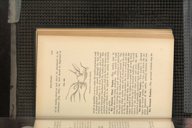 of the tendon about an inch above its attachment to the calcaneum (Fig. 489); the heel should be depressed as FIG. 489. : Tenotomy of tendo-Achillis. much as possible, so as to make the tendon prominent, and a sharp-pointed tenotome passed through the skin and behind the tendon; it is next withdrawn and a blunt- pointed tenotome introduced and the tendon divided. The posterior tibial artery, nerve, and vein lie to the inner side, and are not likely to be injured if the tendon is divided at this point. The Posterior Tibial Tendon.—This tendon may be divided above the inner malleolus. The muscle is made tense by everting the foot, and the tenotome is entered at the inner side of the tendon and passed behind it. The posterior tibial tendon may also be divided upon the side of the foot; for this operation the foot is everted, and the tenotome is passed from above downward and under the upper border of the tendon at a point half an inch below and in front of the tip of the internal malleolus. To avoid injury of the posterior tibial artery and nerve the open operation is generally practised upon this tendon. The Anterior Tibial Tendon.—This tendon is divided upon the dorsal surface of the foot, just below the an- nular ligament of the ankle, midway between the two malleoli. The Peroneal Tendons.—The peroneal tendons may be