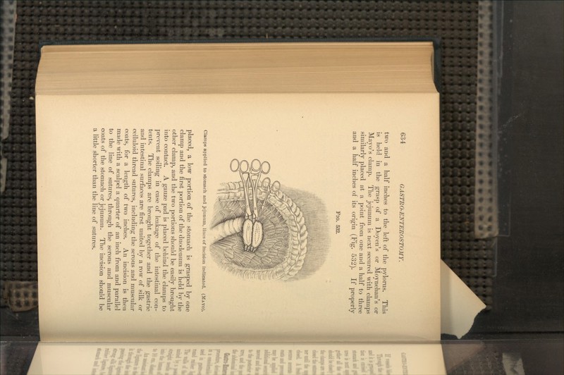 two and a half inches to the left of the pylorus. This is held in the grasp of a Doyen's or Moynehan's or Mayo's clamp. The jejunum is next secured with clamps similarly placed at a point from one and a half to three and a half inches of its origin (Fig. 532). If properly FIG. 532. Clamps applied to stomach and jejunum, lines of Incision indicated. (MAYO). placed, a low portion of the stomach is grasped by one clamp and the first portion of the duodenum is held by the other clamp, and the two portions should be easily brought into contact. A gauze pad is placed behind the clamps to prevent soiling in case of leakage of the intestinal con- tents. The clamps are brought together and the gastric and intestinal surfaces are first united by a row of silk or celluloid thread sutures, including the serous and muscular coats, for a length of two inches. An incision is then made with a scalpel a quarter of an inch from and parallel to the line of sutures, through the serous and muscular coats of the stomach or jejunum. The incision should be a little shorter than the line of sutures.