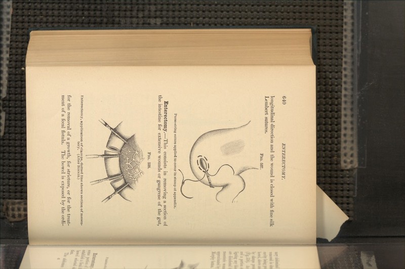 longitudinal direction and the wound is closed with fine silk Lembert sutures. FIG. 537. Purse-string suture applied to cover in stump of appendix. Enterectomy.—This consists in removing a section of the intestine for extensive wounds or gangrene of the gut, FIG. 538. Enterectomy, application of clamps, dotted line shows section of mesen- tery. (After BINNIE.) for the removal of a growth, for stricture, or for the treat- ment of a fecal fistula. The bowel is exposed by the ordi-