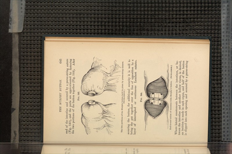 end of the intestine and secured by a purse-string suture (Fig. 543), and the parts are approximated by fastening the two portions of the button together (Fig. 544). After FIG. 543. The two portions of the Murphy button held in place by purse-string sutures. (RICHARDSON.) securing the button, for additional security it is well to bring the gut together over the line of apposition by a layer of interrupted or continuous Lembert sutures. FIQ. 544. End-to-end union of intestine with Murphy's button. (RICHARDSON.) Where lateral anastomosis between the intestines, or be- tween the intestine and another hollow viscus, is desired, an incision is made in each organ, and half of the button is slipped into each opening and secured by a purse-string