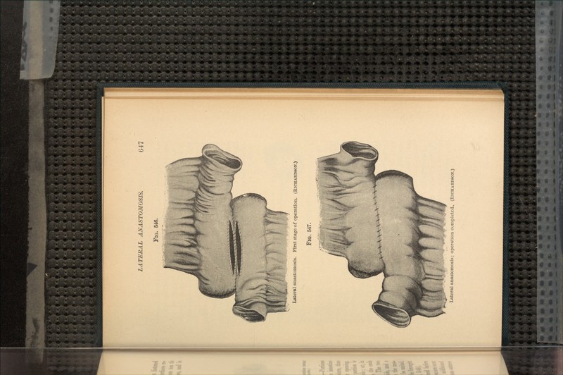 LATERAL ANASTOMOSIS. FIG. 546. 647 Lateral anastomosis. First stage of operation. (RICHARDSON.) FlG. 547. Lateral anastomosis; operation completed, (RICHARDSON.)