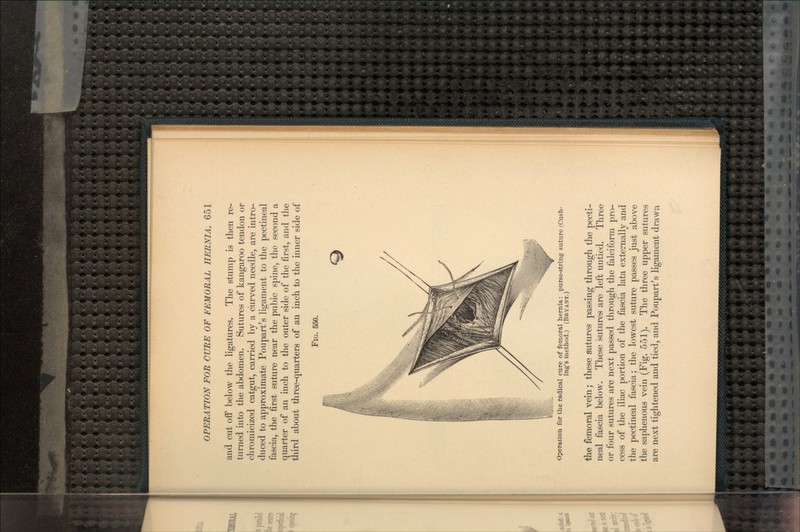 aud cut off below the ligatures. The stump is then re- turned into the abdomen. Sutures of kangaroo tendon or chromicized catgut, carried by a curved needle, are intro- duced to approximate Poupart's ligament to the pectineal fascia, the first suture near the pubic spine, the second a quarter of an inch to the outer side of the first, and the third about three-quarters of an inch to the inner side of FIG. 550. Operation for the radical cure of femoral hernia: purse-string suture (Cush- ing's method.) (BRYANT.) the femoral vein; these sutures passing through the pecti- neal fascia below. These sutures are left untied. Three or four sutures are next passed through the falciform pro- cess of the iliac portion of the fascia lata externally and the pectineal fascia; the lowest suture passes just above the saphenous vein (Fig. 551). The three upper sutures are next tightened and tied, and Poupart's ligament drawu