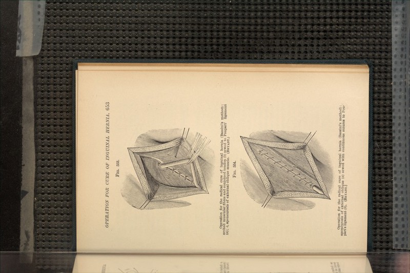 FIG. 553. Operation for the radical cure of inguinal hernia (Bassini's method): arched muscular fibres and conjoined tendon (6) sewed to Poupart' ligament (a); c, aponeurosis of external oblique muscle. (BRYANT.) FIG. 554. Operation for the radical cure of inguinal hernia (Bassini's method): aponeurosis of external oblique (a) sewed with continuous sutures to Pou- part's ligament (6). (BKYANT.)