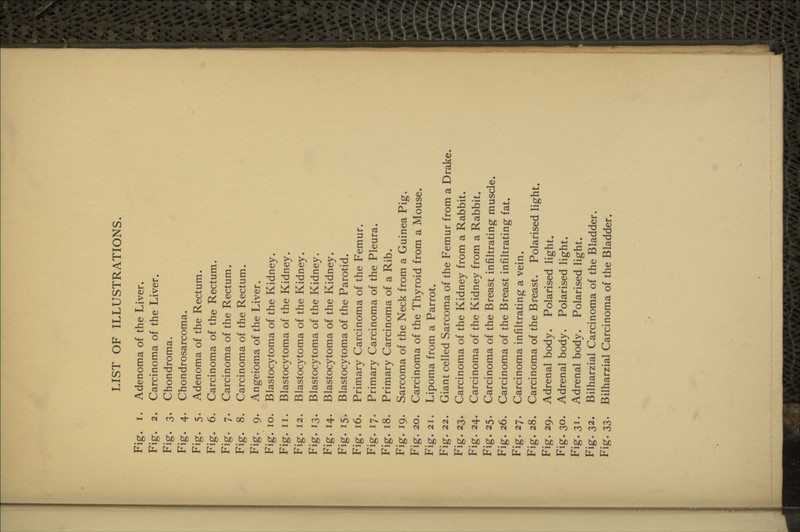 LIST OF ILLUSTRATIONS. Fig. I. Adenoma of the Liver. Fig. 2. Carcinoma of the Liver. Fig* 3* Chondroma. Fig. 4. Chondrosarcoma. Fig. 5. Adenoma of the Rectum. Fig. 6. Carcinoma of the Rectum. Fig. 7. Carcinoma of the Rectum. Fig. 8. Carcinoma of the Rectum. Fig. 9. Angeioma of the Liver. Fig. 10. Blastocytoma of the Kidney. Fig. II. Blastocytoma of the Kidney. Fig. 12. Blastocytoma of the Kidney. Fig. 13. Blastocytoma of the Kidney. Fig. 14. Blastocytoma of the Kidney. Fig. 15. Blastocytoma of the Parotid. Fig. 16. Primary Carcinoma of the Femur. Fig. 17. Primary Carcinoma of the Pleura. Fig. 18. Primary Carcinoma of a Rib. Fig. 19. Sarcoma of the Neck from a Guinea Pig. Fig. 20. Carcinoma of the Thyroid from a Mouse. Fig. 21. Lipoma from a Parrot. Fig. 22. Giant celled Sarcoma of the Femur from a Drake. Fig. 23. Carcinoma of the Kidney from a Rabbit. Fig. 24. Carcinoma of the Kidney from a Rabbit. Fig. 25. Carcinoma of the Breast infiltrating muscle. Fig. 26. Carcinoma of the Breast infiltrating fat. Fig. 27. Carcinoma infiltrating a vein. Fig. 28. Carcinoma of the Breast. Polarised light. Fig. 29. Adrenal body. Polarised light. Fig. 30. Adrenal body. Polarised light. Fig. 31. Adrenal body. Polarised light. Fig. 32. Bilharzial Carcinoma of the Bladder. Fig. :^:^. Bilharzial Carcinoma of the Bladder.