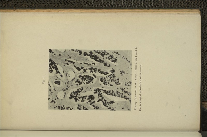 Primary Carcinoma of the Pleura. From a child aged 2. This is a typical spheroidal-celled carcinoma.