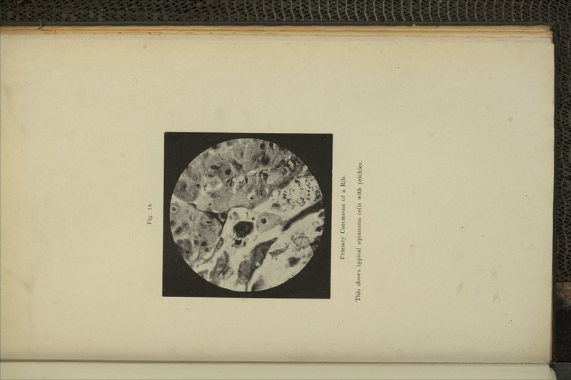 Primary Carcinoma of a Rib. This shows typical squamous cells with prickles.