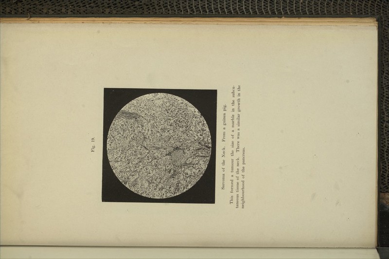 Saixoma of the Neck. From a guinea pig. This formed a tumour the size of a marble in the subcu- taneous tissue of the neck. There was a similar growth in the neighbourhood of the pancreas.