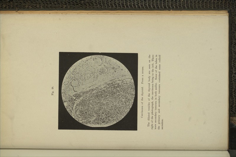 Carcinoma of the thyroid. From a mouse. The dilated vesicles of the thyroid body are seen on the right of the photograph, the carcinoma being to the left. There were secondary tumours in both axillae. Some of the tubes in the primary and secondary tumours contained some colloid secretion.