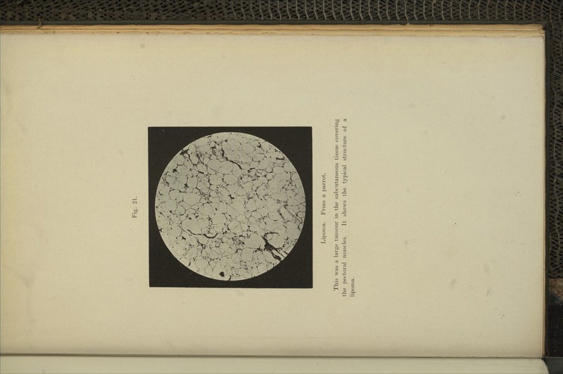 Lipoma. From a parrot. This was a large tumour in the subcutaneous tissue covering the pectoral muscles. It shows the typical structure of a lipoma.