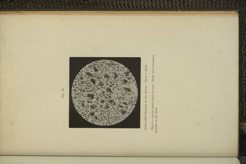 Giant-celled Sarcoma of the Femur. From a drake. This is a typical giant-celled sarcoma. There were secondary growths in the liver.