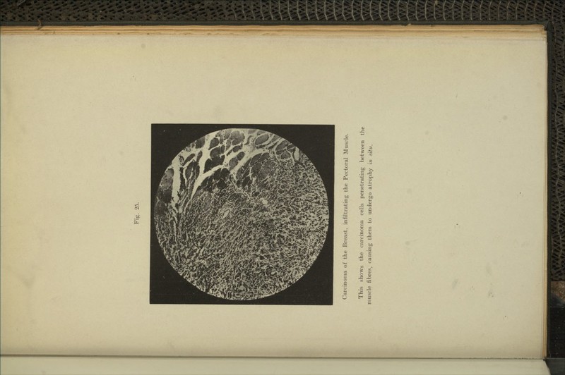 Carcinoma of the Breast, infiltrating the Pectoral Muscle. This shows the carcinoma cells penetrating between the muscle fibres, causing them to undergo atrophy in situ.