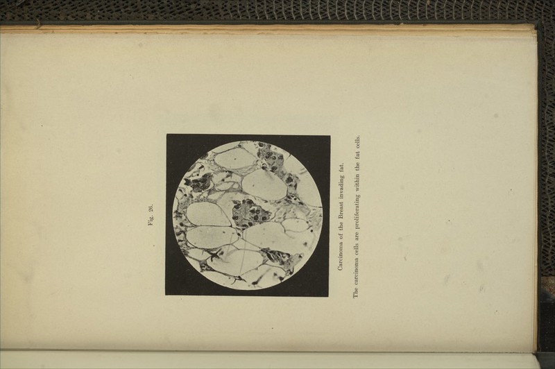 Carcinoma of the Breast invading fat. The carcinoma cells are proliferating within the fat cells.