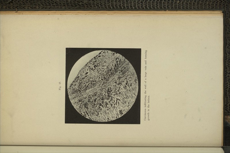 Carcinoma infiltrating the wall of a large vein and forming growth in the intima.
