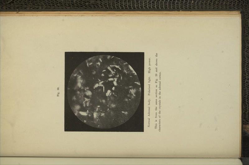 Normal Adrenal body. Polarised light. High power. This is from the same section as Fig. 29 and shows the characters of the crystals in the adrenal cortex.
