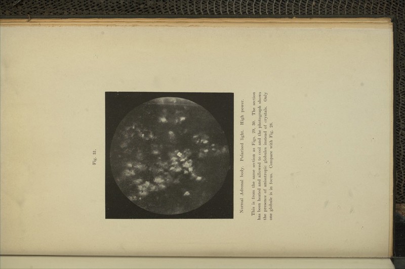 Normal Adrenal body. Polarised light. High power. This is from the same section as Figs. 29, 30. The section has been heated and allowed to cool and the photograph shows the presence of anisotropic globules instead of crystals. Only one globule is in focus. Compare with Fig. 28.