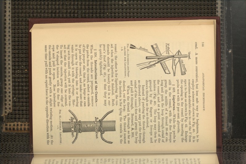 Vessel. mcisi erad. A more convenient, but less safe way for beginners, is to employ scissors as sLown in Fig. 40. It is sometimes desirable also to cut the Tfrom apex to base as shown in Fig. 42. Enlarge the opening in the vessel by inserting the probe wet with 15 per cent, glycerin. § 357. Ligatures.—While the probe is still in the vessel, with the fine forceps grasp the middle of a thread 30-40 cm. long and push the loop through entad of the vessel, and at a point centrad of the incision (Fig. 40). The loop may then be grasped by the fingers or forceps and drawn through as far as desired. Instead of pushing the thread through as du'ected above, one may put the forceps entad of the vessel first and grasp the loop and pull it through. Bernard, A, 263. When the thread is through as far as desired, cut the loop. The thread nearest the incision is for tying the canula in the vessel; the other is for ligaturing the ves- sel when the injection is finished. Both threads should be loosely tied in a sur- geon^ s knot (Fig. 41), so that they may be quickly tightened. § 358. Introduction of the Canula.— When the threads are prepared, remove the probe from the vessel, select a canula of the proper size, that is, as large as can be put into the vessel, and make sure that it is open by blowing into it or forcing water through it with the syringe. Hav- ing wet its small end, put it into the ves- sel so that the injection will be centrad. To insert the canula, grasp one edge of the V-shaped incision with the fine for- ceps and pull it open. Now introduce the canula and push gently with a slight twisting motion. At the same time pull with an equal force in the opposite direction with the Fig. 40.—Incisions and Prep- aration FOB LlGATUKING ; X.5. Fig. 41.—Double xl. Ligature