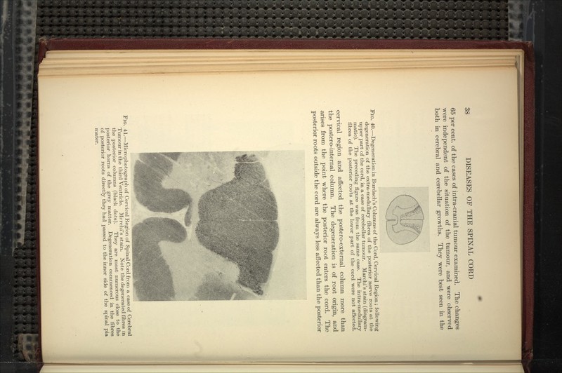 65 per cent, of the cases of intra-cranial tumour examined. The changes were independent of the situation of the tumour, and were observed both in cerebral and cerebellar growths. They were best seen in the Pig. 40.—Degeneration in Burdach's Columns of the Cord, Cervical Region; following degeneration of the oxtra-medullary fibres of the posterior nerve roots at the upper part of the cord, in a case of cerebellar tumour. Marchi's stain (diagram- matic). The preceding figure was from the same case. The intra-medullary fibres of the posterior roots at the lower peirt of the cord were not affected. cervical region and affected the postero-external column more than the postero-internal column. The degeneration is of root origin, and arises from the point where the posterior root enters the cord. The posterior roots outside the cord are always less affected than the posterior Fig. 41.—Microphotograph of Cervical Region of Spinal Cord from a case of Cerebral Tumour in the third Ventricle. Mprchi's stain. Note the degenerated fibres m the posterior columns (black dots). They are most numerous close to the posterior horns of the grey matter. Degeneration commenced in the fibres of posterior roots directly they had passed to the irmer side of the spinal pia mater.