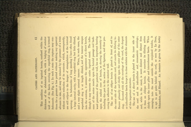 This condition of an inguinal hernia, confined within the thickness of the abdominal walls, with a bulging of anterior wall or of the fascia covering the superficial ring, is termed bubonocele. (See Fig. 4.) In such a state the rupture may con- tinue for a greater or less period without making any apparent advance in size, and may be retained by the pressure of a truss without entire reduction of its contents; which, consequently, are still subject to the danger of strangulation at the internal opening. In bubonoceles of long standing I have often found a large internal cavity, with a superficial ring but little dilated, and a very slight external tumour. When, in such cases, the superficial ring is at length dilated, and the tumour escapes into the scrotum, it assumes the appearance of a direct hernia, though it may traverse the entire inguinal canal. The influ- ence of the rectus muscle upon the hernial passage and back- ward protrusion of the posterior wall, has an important bearing upon the radical cure of hernia, as showing the necessity of including this part in the action of the ligature, and thus pro- curing its adhesion to the anterior wall. The sac of an oblique hernia is placed in front of, and to the outer side of the spermatic cord, and exerts its dilating in- fluence primarily and chiefly upon the outer pillar of the outer ring. Invested with all the coverings of the cord, the deepest or infundibular fascia keeps it in close relation with the elements of this important structure. The sac of a direct hernia is placed to the inner side of the cord and its infundibular and cremasteric coverings; and, while in the canal, is more distinct and distant from it than an oblique hernia. It exercises its dilating action chiefly upon the inner pillar and intercolumnar fascia. When emerging into the canal outside the conjoined tendon, it is apt to get quite behind the cord, as seen by Le Dran, Schmucker, and Blizard. An instance is given by Sir Astley