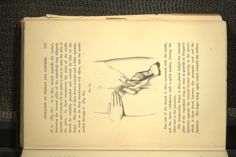 of it. (Fig. 24.) It is then turned towards the surface, traversing the internal pillar of the superficial ring obliquely upwards and inwards, till the point is seen to raise the skin of the groin. In these manosuvres the point of the needle should be carefully preceded and covered by that of the finger. The skin is then drawn inwards and a little upwards, as much as its deep attachments will allow, and the needle pushed through it. (Fig. 25.) FIG. 25. One end of the thread is then connected with the needle, and the latter withdrawn with a quick motion, leaving the other end in the puncture. The invaginating finger is then placed behind the external pillar of the superficial ring, as close as possible to Poupart's ligament, opposite the internal hernial opening, in the groove which is there found between the spermatic cord and the ligament. The finger being again raised towards the surface,