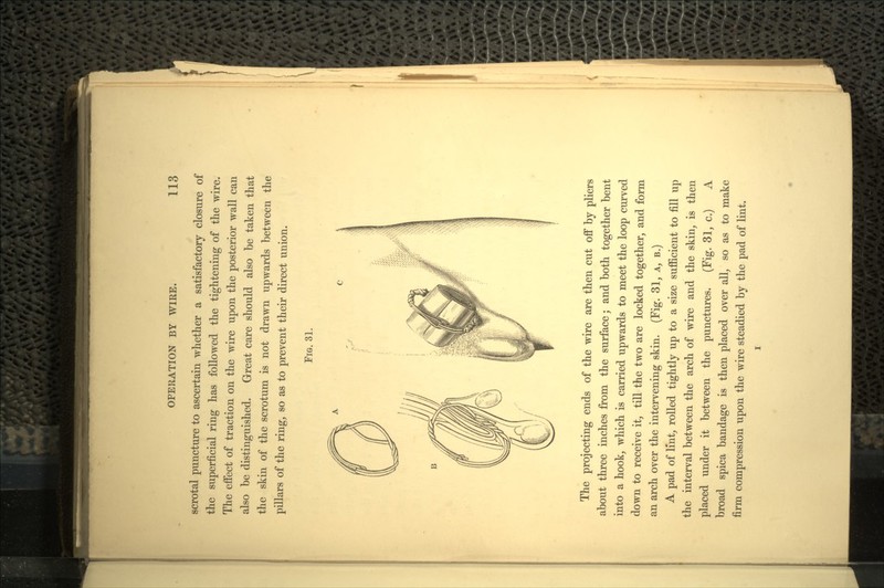 scrotal puncture to ascertain whether a satisfactory closure of the superficial ring has followed the tightening of the wire. The effect of traction on the wire upon the posterior wall can also be distinguished. Great care should also be taken that the skin of the scrotum is not drawn upwards between the pillars of the ring, so as to prevent their direct union. FIG. 31. The projecting ends of the wire are then cut off by pliers about three inches from the surface; and both together bent into a hook, which is carried upwards to meet the loop curved down to receive it, till the two are locked together, and form an arch over the intervening skin. (Fig. 31, A, B.) A pad of lint, rolled tightly up to a size sufficient to fill up the interval between the arch of wire and the skin, is then placed under it between the punctures. (Fig. 31, c.) A broad spica bandage is then placed over all, so as to make firm compression upon the wire steadied by the pad of lint.