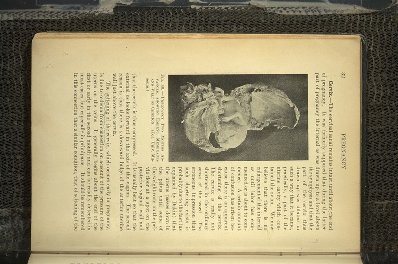 Cervix.—The cervical canal remains intact until about the end of pregnancy. It was formerly supposed that during the latter part of pregnancy the internal os was drawn up to a level above the symphysis and that the part of the cervix thus drawn up was dilated in such a way that it became, practically, a part of the uterine cavity which con- tained the ovum. We now believe that there is no enlargement of the internal os until labor has com- menced or is about to com- mence. A certain amount of confusion has arisen be- cause there is an apparent shortening of the cervix. The cervix is really not shortened in the ordinary sense of the word. The erroneous impression that such shortening exists is probably due to the fact (as explained by Dakin) that the uterus passes down in the pelvis until some of the weight rests on the pel- posterior vaginal wall and that the cervix is thus compressed. It is usually bent so that the external os looks forward in the axis of the vagina. The second reason is that there is a downward bulge of the anterior uterine wall just above the cervix. The softening of the cervix, which occurs early in pregnancy, is due to oedema from congestion on account of the pressure of the uterus on the veins. It generally begins about the end of the first or early in the second month and can be readily detected in most cases, but especially in primiparse. It should be remembered in this connection that a similar condition, that of softening of the FIG. 40. — PREGNANCY Two MONTHS AD- VANCED, SHOWING EMBRYO, MEMBRANES AND VILLI OF CHORION. (Tor. Univ. Mu-
