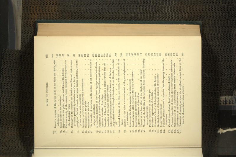 no. PAOI 7'2. Eccentric atrophy of the lower ends of the tibia and fibula, with osteoporosis . . •. •. •. . . . . . . 142 73. Senile atrophy of the calvarium. . . . . . . 143 74. Hypoplasia of the pubis, ischium, and ilium of the left side . . 144 7).' Extreme atrophy of the cranial bones produced by the pressure of the developing brain 145 76. Deformity of the superior and inferior maxillae and their alveolar processes produced by cicatrisation after a burn .... 146 77. Atrophy of the last thoracic and upper lumbar vertebrae, from the pressure of an aortic aneurysm 147 78. Section of a vertebra affected with osteomalacia . . . .150 79. Osteomalacia of the pelvis 151 80. Osteomalacia of the tibia 152 81. The formation of new bone on the surface of old bone by means of a layer of osteoblasts 155 8,2. Myelogenous formation of bone from aggregations of osteoblasts . 156 83. Formation of osteoid trabeculae from proliferous periosteum . . 157 84. Periosteal formation of cartilage 157 85. Formation of bone from cartilage in a callus fourteen days old . 158 86. Formation of bone from connective tissue 158 87. Proliferous periosteum four days after fracture of the bone . . 161 88. Longitudinal section through a fracture of the fibula fourteen days old . . .162 89. Reunited fracture of the tibia and fibula, with synostosis of the bones 164 90. Fracture of the spine nine months old, with great displacement of the vertebrae 165 91. Fracture of the fibula, repaired by syndesmosis .... 166 92. Pseudo-arthrosis after fracture of the neck of the femur . . . 167 93. Resorption and apposition of bone . . . . . . .168 94. Apparent dilatation of the radius ....... 169 95. Necrosis of the lower third of the diaphysis of the femur . . 172 96. Xecrosis of the left tibia with periosteal bone-formation, following acute osteomyelitis ...... I .. 172 97. Phosphorus-necrosis of the lower jaw ...... 176 98. Periosteal hyperostosis of the tibia ....... 177 99. Skeleton of a hand with hyperostosis of the bones .... 178 100. Ostitis deformans of the head and neck of the femur . . . 179 101. Spondylitis deformans 180 102. Fungous granulations with tubercles from the spongy tissue of the calcaneutn 183 103. Central tuberculosis of bone in an advanced stage .... 185 104. Periosteal deposition of bone in chronic myelogenous tuberculosis . 186 105. Osteosclerosis of the femur resulting from chronic tuberculosis . 187 •J06. Tuberculosis of the spinal column 188 107. Formation of osteophytes upon the atrophied cortical layer of the femur in chronic tuberculous arthritis . . 189