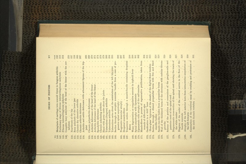 no. PAOB 146. Metaplasia of cartilage into mucoid tissue in fungous arthritis . 249 147. Preliminary stage of fibrous intercartilaginous ankylosis . . 253 148. Fibrous intercartilaginous ankylosis . - 254 149. Complete bony ankylosis of the head of the femur with the ace- tabulum 255 150. Nearthrosis of the hip . • 257 151. Bony ankylosis of the lower jaw 258 152. Chronic dry ulcerative arthritis 265 153. Chronic arthritis deformans ........ 267 154. Arthritis and ostitis deformans with arborescent lipoma of the hip- joint 268 155. Chronic polyarthritis deformans ....... 269 156. Arthritis deformans of the head of the femur ..... 270 157. Arthritis deformans of the head of the femur ..... 271 158. Spondylitis deformans 274 159. Chronic ankylosing arthritis ........ 276 160. Hand with gouty nodes about the joints ...... 279 161. Tuberculous (fungous) arthritis 283 162. Tuberculous arthritis 284 163. Tuberculous caries about the acetabulum of the left hip-joint . 285 164. Section through an atrophic muscular bundle from a case of pro- gressive spinal amyotrophy ........ 296 165. Progressive muscular atrophy ........ 297 166. Dropsical muscle-fibres ......... 298 167. Transverse section through a muscle-bundle containing dropsical fibres 298 168. Waxy degeneration or coagulative necrosis in typhoid fever . . 298 169. Spinal amyotrophy with lipomatosis ...... 301 170. Lipomatosis with atrophy of the calf-muscles ..... 302 171. Muscle-fibres in process of regenerative proliferation, taken from wounds of different ages ........ 304 172. Ossification in a ' drill' bone . . . . . . . .311 173. ' Hour-glass' hygroma of the sheath of the digital flexor tendons . 315 174. Section through a dilated prepatellar bursa with free and fixed rice-like bodies .......... 318 175. Sessile rice-like bodies from a prepatellar bursa .... 318 176. Wall of the thickened bursa of the olecranon with nodular fibrous growths ........... 319 177. Scheme of the position and connexions of the ganglion-cells and posterior roots of the spinal cord ....... 324 178. Diagrammatic cross-section of the spinal cord showing the tracts of the white matter 325 179. Diagram of the nuclei of the cerebral nerves in the floor of the fourth ventricle 326 •J.80. Atrophy of the left anterior horn from intra-uterine amputation of the left fore-arm 330 181. Contraction of the vertebral canal by crushing and protrusion of the sixth thoracic vertebra . . . 331