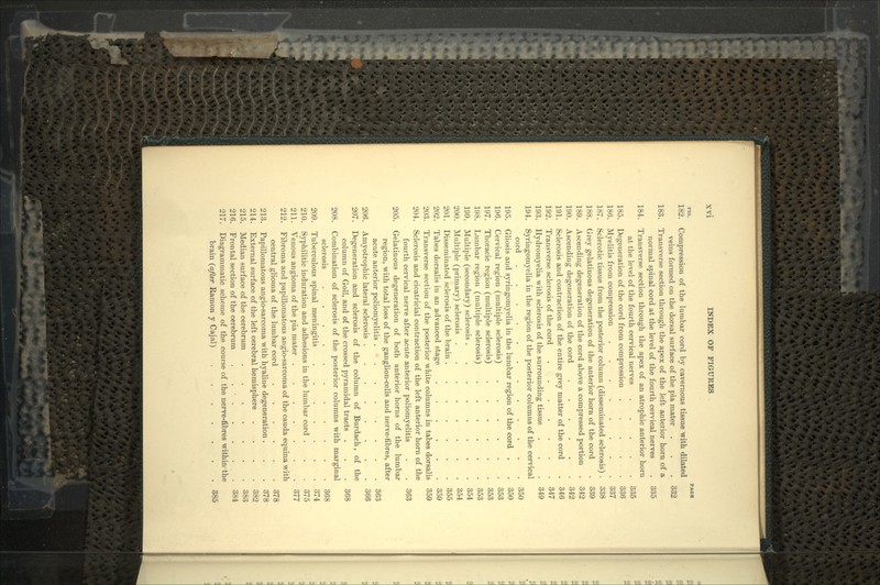 FIO. PACK 182. Compression of the lumbar cord by cavernous tissue with dilated veins formed on the dorsal surface of the pia mater . . . 332 183. Transverse section through the apex of the left anterior horn of a normal spinal cord at the level of the fourth cervical nerves . 335 184. Transverse section through the apex of an atrophic anterior horn at the level of the fourth cervical nerves . . . . . 335 185. Degeneration of the cord from compression 336 186. Myelitis from compression 337 187. Sclerotic tissue from the posterior column (disseminated sclerosis) . 338 188. Grey gelatinous degeneration of the anterior horn of the cord . 339 189. Ascending degeneration of the cord above a compressed portion . 342 190. Ascending degeneration of the cord 342 191. Sclerosis and contraction of the entire grey matter of the cord . 346 192. Transverse sclerosis of the cord 347 193. Hydromyelia with sclerosis of the surrounding tissue . . . 349 194. Syringomyelia in the region of the posterior columns of the cervical cord ............ 350 195. Gliosis and syringomyelia in the lumbar region of the cord . . 350 196. Cervical region (multiple sclerosis) 353 197. Thoracic region (multiple sclerosis) 353 198. Lumbar region (multiple sclerosis) 353 199. Multiple (secondary) sclerosis 354 200. Multiple (primary) sclerosis 354 201. Disseminated sclerosis of the brain 355 202. Tabes dorsalis in an advanced stage 359 203. Transverse section of the posterior white columns in tabes dorsalis 359 204. Sclerosis and cicatricial contraction of the left anterior horn of the fourth cervical nerve after acute anterior poliomyelitis . . 363 205. Gelatinous degeneration of both anterior horns of the lumbar region, with total loss of the ganglion-cells and nerve-fibres, after acute anterior poliomyelitis . . . . . . . . 363 206. Amyotrophic lateral sclerosis 366 207. Degeneration and sclerosis of the column of Burdach, of the column of Goll, and of the crossed pyramidal tracts . . . 368 208. Combination of sclerosis of the posterior columns with marginal sclerosis 368 209. Tuberculous spinal meningitis 374 210. Syphilitic induration and adhesions in the lumbar cord . . . 375 211. Venous angioma of the pia mater 377 212. Fibroma and papillomatous angio-sarcoma of the cauda equina with central gliorna of the lumbar cord 378 213. Papillomatous angio-sarcoma with hyaline degeneration . . . 378 214. External surface of the left cerebral hemisphere .... 382 215. Median surface of the cerebrum ....... 383 216. Frontal section of the cerebrum . . • . . . . . 384 217. Diagrammatic scheme of the course of the nerve-fibres within-the brain (after Ramon y Cajal) . 385