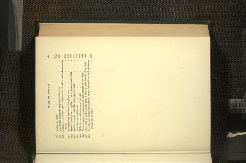 FIO. PAG* 298. Ichthyotic wart 556 299. Congenital cavernous angioma of the skin 557 300. Section of a hypertrophic angioma of the skin and subcutaneous tissue 558 301*. Subcutaneous cavernous lymphangioma 559 302. Section through two papillae from a tuberous hard wart . . 560 303. Section through a slightly tuberous soft wart 561 304. Neurofibroma molluscum 562 305. Multiple neurofibromata of the skin 563 306. Neuromatous elephantiasis or pachyderm ia of the thigh . . . 564 307. Skin with neurofibromata from a case of pachydermia (Fig. 306) . 565 308. Atrophy and cystic degeneration of the hair-follicles and sebaceous glands of the scalp ......... 571