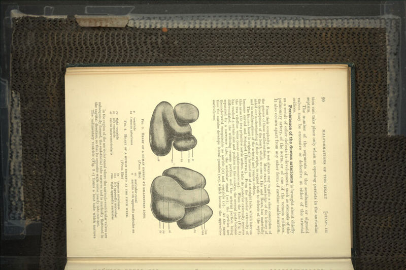 tion can take place only when an opening persists in the auricular septum. The number of the segments of the semilunar or sigmoid valves may be excessive or defective at either of the arterial orifices. Persistence of the ductus arteriosus is brought about chiefly as a result of other defects in development, such as stenosis of the pulmonary artery, of the aorta, or of one of the venous orifices. It also occurs apart from any other form of cardiac malformation. From their complexity, it is not always easy to gain a clear conception of the genesis of these malformations. More exact knowledge of the history of the development of the heart, which we owe to His and BORN, has materially aided our understanding of their origin, in regard both to defects of the septa and to malformations of the arterial and venous orifices. The human heart is originally formed out of a straight tube, which later on becomes curved and S-shaped (HERTWIG). From the anterior extremity of this arise the two primitive aortic arches, while its posterior extremity receives the two vitelline veins (venae omphalo-mesentericne). When the tube (Fig. -'5) has reached a certain size and position in the embryo, the several parts become differentiated, the widening venous portion and the arterial portion being separated by a narrower tube, the auricular canal (<tc); the cavities are thenceforward recognisable as auricle (a) and ventricle (v). At the same time the auricles develope lateral pouches (an), which become the appendices auricularum. FIG. 3. HEART OF A HUMAN EMBRYO 4-3 MILLIMETRES LONG. (From His) v ventricle ac auricular canal to, truncus arteriosus a auricle with appendix auriculae aa Fio. 4. HEART OF A HUMAN EMBRYO AT THE FIFTH WEEK. (From His) rv right ventricle ta truncus arteriosus Iv left ventricle laa left appendix auriculae si sulcus iuterventricularis raa right appendix auriculae In the region of the auricular canal where the auriculo-ventriculav valves are subsequently formed, the endothelial tube narrows and is markedly flattened in the sagittal direction, so that its opposite walls come nearly into contact. The rudimentary ventricle (Fig. 3 v) forms a bent'tube which narrows