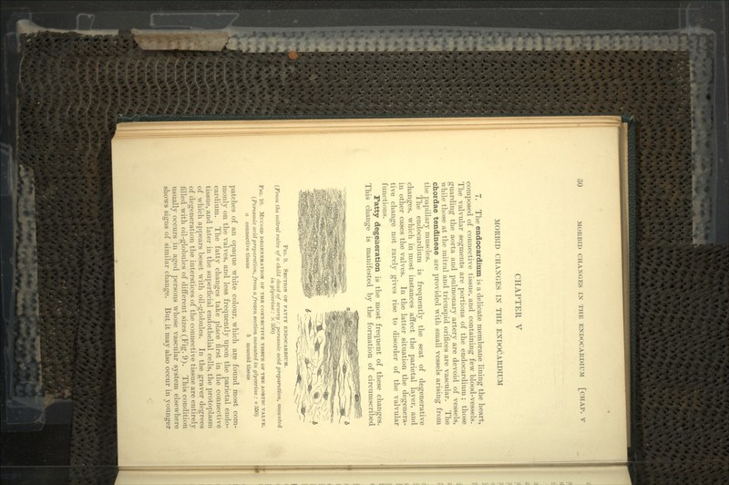 CHAPTER V MORBID CHANGES IX THE ENDOCARDIUM 7. The endocardium is a delicate membrane lining the heart, composed of connective tissue, and containing few blood-vessels. The valvular segments are portions of the endocardium; those guarding the aorta and pulmonary artery are devoid of vessels, while those at the mitral and tricuspid orifices are vascular. The chordae tendineae are provided with small vessels arising from the papillary muscles. The endocardium is frequently the seat of degenerative changes, which in most instances affect the parietal layer, and in other cases the valves. In the latter situation the degenera- tive change not rarely gives rise to disorder of the valvular functions. Fatty degeneration is the most frequent of these changes. This change is manifested by the formation of circumscribed FIG. 9. SECTION OF FATTY ENDOCARDIUM. (From the mitral valve of a child dead of scurvy: perosmic acid preparation, mounted in glycerine: X 330) FlG. 10. MUCOID DEGENERATION OF THE CONNECTIVE TISSUE OF THE AORTIC VALVE. (Perosmic acid preparation, from a frozen section mounted in glycerine : x 350) a connective tissue 6 mucoid tissue patches of an opaque white colour, which are found most com- monly on the valves, and less frequently upon the parietal endo- cardium. The fatty changes take place first in the connective tissue, and later in the superficial endothelial cells, the protoplasm of which appears beset with oil-globules. In the graver degrees of degeneration the interstices of the connective tissue are entirely filled with oil-globules of different sizes (Fig. 9). This condition usually occurs in aged persons whose vascular system elsewhere shows signs of similar change. But it may also occur in younger