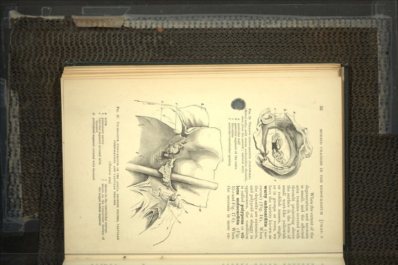 r t FlO. 15. VlLLOUS ENDOCARDITIS (POLYPOSA). Mitral valve, with recent endocarditic thrombi, seen from the auricle; natural size) a auricular wall 6 posterior segment of the valve c thrombus e aurieulo-ventricular opening When the extent of the degeneration and necrosis is small, and the affected area remains covered with thrombi projecting above the surface in the form of small wart-like yellowish or reddish masses, single, or in groups or rows, we have the variety known as warty endocarditis (ver- rucoiscT) (Fig. 14). When the deposits are extensive, and polypoid or shaggy in appearance, the condition is called polypous or vil- lous endocarditis (Fig. 15 <? and Fig. 176). When the necrosis is more ex- Fir,. 16. ULCERATIVE ENDOCARDITIS OF THE AORTA, SHOWING ULCERS, VALVULAB, PERFORATIONS. AND VALVULAR THROMBI. (Natural size) e ulcers on the ventricular septum a aorta 6 pulmonary artery c valvular segment covered with thrombi d perforated segment covered with thrombi ulcers on the ventricular surface of the larger mitral segment