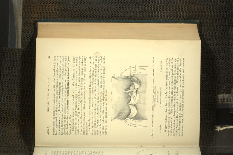 tensive and the necrotic tissue and the thrombi formed on it have been separated, so that ulcerous excavations are visible, we have an ulcerous or diphtheritic endocarditis. Sometimes the in- fri-tc.d thrombi are east off, and passing into the circulation lodge elsewhere in the tissues as foci of suppuration : the process may then be described as pyaemic or suppurative endocarditis (pux- tulosa) (Fig. 13). Ulceration may be combined with the formation of warty thrombi in the most various ways. On the margins of an endo- carditic ulcer (Fig. 1C c d and Fig. 17 6), new thrombi are apt to form, but they are usually larger and looser than in endocar- ditis verrucosa, and often possess rather a villous than a warty appearance. As already stated, endocarditis most frequently affects the val- vular apparatus, more rarely the parietal endocardium of the left heart, still more rarely the endocardium of the right heart; it is most frequently observed in the latter situation when the endo- carditis is due to traumatic infection. In the course of left-sided valvular endocarditis, warty deposits may also be formed on the valves of the right side of the heart. FIG. 17. ENDOCARDITIS (VILLOSA), WITH VALVULAR THROMBI, AND ACUTH VALVULAR ANEURYSM. a aorta (Xatural size) b valvular thrombus c aneurysm Warty endocarditis affects chiefly the free margins of the val- vular segments ; the ulcerative forms are less frequently confined to this situation. The ulceration attacks different portions of the valyes, and very frequently spreads to the chordae tendineae, and to the walls of the aorta and of the heart. When the tissue of a valvular segment is gradually destroyed on one side, the diseased a n-a sometimes yields under the pressure of the blood, and thus may