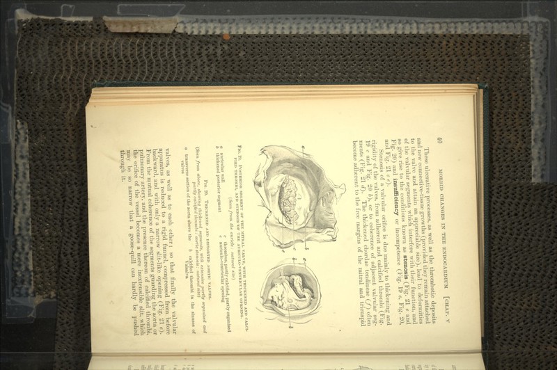 These ulcerative processes, as well as the thrombotic deposits and new connective-tissue growths (provided they remain attached to the valve and attain an appreciable size), lead to deformities of the valvular segments which interfere with their function, and so give rise to the conditions known as stenosis (Fig. 21 e and Fig. 20) and insufficiency or incompetence (Fig. 19 e, Fig. 20, and Fig. 21 c e). Stenosis of a valvular orifice is due mainly to thickening and rigidity of the valves, from adherent and calcined thrombi (Fig. 19 c and Fig. 20 6), or to coherence of adjacent valvular seg- ments (Fig. 21 cT). The thickened chordae tendineae (/) often become adherent to the free margins of the mitral and tricuspid FIG. 19. POSTERIOR SEGMENT OF THE MITRAL VALVE, WITH THICKENED AND CALCI- FIED THROMBI, AND STENOSIS OF THE AURICULO-VENTRICULAR OPENING. (Seen from the auricle : natural size) a auricular wall c thrombus, partly calcified, partly organised b thickened posterior segment e auriculo-ventricular opening FIG. 20. THICKENED AND DISTORTED AORTIC VALVES. (Seen from above, showing thickened segments, with extensive partly organised and partly calcified thrombi: aortic stenosis: natural size) transverse section of the aorta above the valves calcified thrombi in the sinuses of Valsalva valves, as well as to each other; so that finally the valvular apparatus is reduced to a rigid funnel, compressed from before backward, and with only a narrow slit-like opening (Fig. 21 e*). From the mutual coherence of the segments guarding the aorta or pulmonary artery, and the presence thereon of calcified thrombi, the orifice of the vessel becomes a mere inextensible slit, which may be so narrow that a goose-quill can hardly be pushed through it.