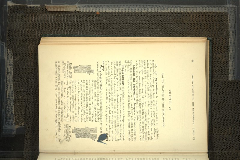 CHAPTER VI MORBID CHANGES IX THE MYOCARDIUM 10. The myocardium is composed chiefly of cylindrical muscle-cells, whose protoplasm is to a great extent differenti- ated into transversely-striated fibrils; these fibrils are firmly united together at their ends or by lateral branches, and are surrounded by a connective tissue containing blood-vessels. Pathological changes may take place both in the muscle-cells and in the connective tissue, but they are more commonly met with in the former structures than in the latter. Atrophic and degenerative changes of the muscle-cells are those that most frequently occur, and they are often the cause of death. In such a case death takes place through paralysis of the heart. Simple atrophy of the heart-muscle is a frequent accompani- ment of senile decay, and of premature marasmus due to malig- nant disease, pulmonary tuberculosis, and other affections. It is indicated by a decrease in the size of the muscle-cells, and often also by a simultaneous increase of yellow pigment-granules within them (Fig. 22), so that the atrophied heart-muscle acquires a brownish colour, the condition being spoken of as atrophy. Fatty degeneration of the heart-muscle is apt to occur course of various forms of poisoning, of infective diseases, and of long-continued fever; also, and very frequently, as a consequence of chronic gen- eral and local anaemia, as in steno- sis of the coronary arteries, and of general disorders of the circula- tion, as in valvular disease with imperfect compensation and in pulmonary emphysema, in which the gaseous interchanges neces^ sary for the functional activity of the blood are interfered with. Histologically, fatty degeneration is characterised by the appearance of small oil-globules in the muscle-cells (Fig. 23); these are mostly arranged in rows, and FIG. 22. BROWN ATROPHY OF THE CARDIAC MUSCLE. (Teased prepara- tion: X 3oO) FIG. 23. FATTY DEGENERATION OF THE CARDIAC CLE. (X350)