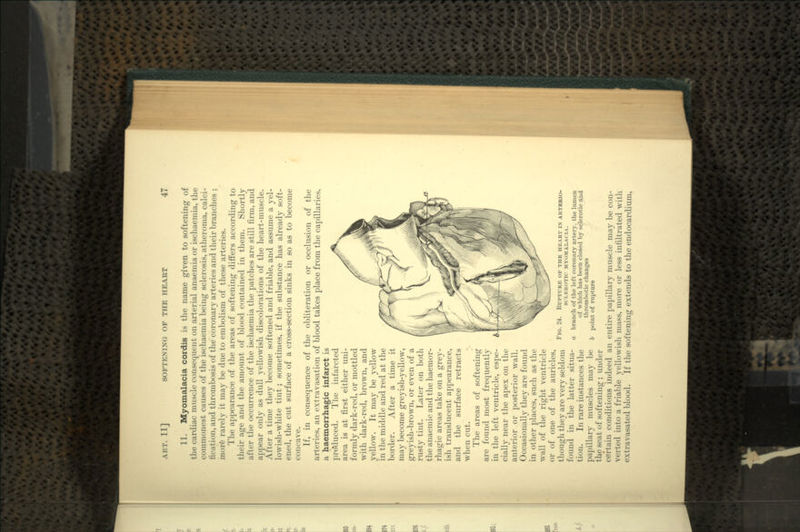 11. Myomalacia cordis is the name given to softening of the cardiac muscle consequent on arterial anaemia or ischaemia, the commonest causes of the ischaemia being sclerosis, atheroma, calci- tication, and thrombosis of the coronary arteries and their branches ; more rarely it may be due to embolism of these arteries. The appearance of the areas of softening differs according to their age and the amount of blood contained in them. Shortly after the occurrence of the ischaemia the patches are still firm, and appear only as dull yellowish discolorations of the heart-muscle. After a time they become softened and friable, and assume a yel- lowish-white tint; sometimes, if the substance has already soft- ened, the cut surface of a cross-section sinks in so as to become concave. If, in consequence of the obliteration or occlusion of the arteries, an extravasation of blood takes place from the capillaries, a haemorrhagic infarct is pro'duced. The inlarcted area is at first either uni- formly dark-red, or mottled with dark-red, brown, and yellow. It may be yellow in the middle and red at the border. After a time it may become greyish-yellow, greyish-brown, or even of a rusty tint. Later on both the anaemic and the haemor- rhagic areas take on a grey- ish translucent appearance, and the surface retracts when cut. The areas of softening are found most frequently in the left ventricle, espe- cially near the apex on the anterior or posterior wall. Occasionally they are found in other places, such as the wall of the right ventricle or of one of the auricles, though they are very seldom found in the latter situa- tion. In rare instances the papillary muscles may be the seat of softening ; under certain conditions indeed an entire papillary muscle may be con- verted into a friable yellowish mass, more or less infiltrated with extravasated blood. If the softening extends to the endocardium, FIG. 24. RUPTURE OF THE HEART ix ARTERIO- SCLEROTIC MYOMALACIA. branch of the left coronary artery, the lumen of which has been closed by sclerotic and thrombotic changes point of rupture