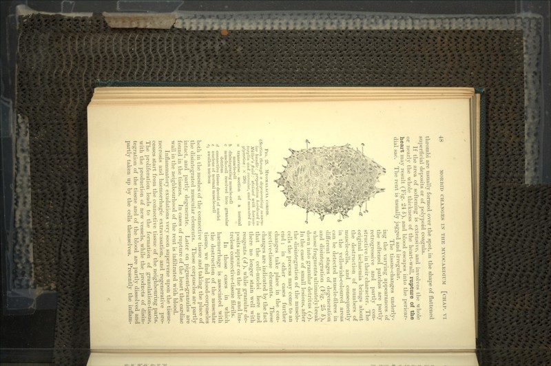 thrombi are usually formed over the spot, in the shape of flattened superficial deposits or of polypoid coagula. If the area of softening is extensive, and involves the whole or nearly the whole thickness of the heart-wall, rupture of the heart may result (Fig. 24 6), and blood escapes into the pericar- dial sac. The rent is usually jagged and irregular, The tissue-changes underly- ing the varying appearances of the softened patches are partly retrogressive and partly con- structive in their character. The £—~T~jt'* SB B9BB3r?v, original ischaemia brings about the destruction of numbers of muscle-cells, and consequently in the yellowish-coloured areas can be detected muscle-fibres in different stages of degeneration and disintegration (Fig. 25 6), whose fragments ultimately break down into granular detritus (<?). In the case of small lesions, after the disintegration of the muscle- cells the process may come to an end ; in other cases further changes take place in the con- nective-tissue elements. These changes are indicated by the fact that the cell-nuclei here and there no longer stain well with reagents (^), while granular de- posits appear on the pale and lus- treless connective-tissue fibrils. In those cases in which haemorrhage is associated with the destruction of the muscular tissue, we find blood-corpuscles both in the meshes of the connective tissue and taking the place of the disintegrated muscular elements. These corpuscles are partly intact, and partly degenerate. Later on pigment-granules are found in the tissues. In cases of rupture of the heart the cardiac wall in the neighbourhood of the rent is infiltrated with blood. Inflammatory exudations very soon supervene upon the tissue- necrosis and haemorrhagic extravasation, and regenerative pro- cesses start from the connective tissue of the neighbouring parts. The proliferation leads to the formation of granulation-tissue, with the production of new vessels, while the products of disin- tegration of the tissue and of the blood are partly dissolved and partly taken up by the cells themselves. Presently the inflam- FKI. 25. MYOMALACIA CORDIS. (Section through a degenerating muscu- lar bundle : preparation hardened in Miiller's fluid: stained with haema- toxijlin and carmine, and mounted in glycerine: X 250) a transverse • section of a normal muscle-cell b disintegrating muscle-cell c muscle-cell resolved into granular detritus d connective tissue devoid of nuclei e nucleus of normal muscle-cell e\ swollen nucleus