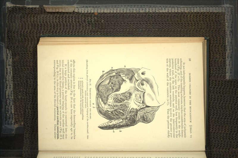 It not infrequently happens, however, that the area of ischaemic softening, and of the resulting sclerosis, reaches considerable dimen- sions (Fig. 27 a 6). This most commonly occurs in the neigh- bourhood of the apex on the anterior wall, less frequently in the posterior wall, of the left ventricle, and on the interventricular septum, where the cicatrices sometimes involve the greater por- tion of the wall of the ventricle (a A). That the process chiefly a 1) . FIG. 27. THROMBOSIS WITHIN THE HEART. (Resulting from fibroid induration and aneurysmal bulging of the cardiac wall: two- thirds natural size) a sclerotic patch with thickened endocardium b libroid induration of the myocardium c thrombus affects this region is due to the fact that the descending branches of the coronary arteries (Fig. 28 a) are here especially apt to be constricted and occluded. If a large portion of the heart-muscle is converted into cica- tricial connective tissue, a partial bulging of the cardiac wall may occur, due to the blood-pressure upon the sclerotic area (Fig. 27 b and Fig. 28 6) ; in this way is formed a partial cardiac aneurysm, corresponding to the area of the fibroid induration. These aneur-