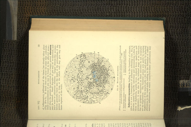 of inflatnmatory infiltration of the tissue has already taken place (Fig. 29 a b). If death does not occur for some time yellowish- white accumulations of pus may be found in the affected areas ; and when the patient has survived for a longer period abscesses may be formed. Small deposits of pus may be re-absorbed, and leave scars or calcareous residues. Larger abscess-like accumu- lations generally burst into the heart or the pericardium, if the patient survive so long, or the whole wall may give way and cause rupture of the heart. FIG. 2J». MYCOTIC MYOCARDITIS. (From a cas« of puerperal parametritis : preparation hardened in alcohol, stained with gentian-violet and vesuvin, and mounted in Canada balsam : X 300) a intravascular colonies of Staphylococcuft b cellular infiltration transverse section of muscles intermuscular connective tissue Indurative myocarditis, leading to the formation of scleroses, when it is not a consequence of ischaemic softening (Art. 11), is likewise caused by specific infections and intoxications (often by those of diphtheria, scarlet fever, typhoid fever, small-pox, and pneumonia) ; it may also be the terminal stage of an infection due to pyogenic micrococci, as these microbes do not invariably set up suppuration. The bacterial poison acts partly by causing degeneration of the muscle-cells (Art. 10) and partly by inducing alterations in the vessel-walls, leading to the formation of inflam- matory infiltrations, in which connective-tissue proliferation may