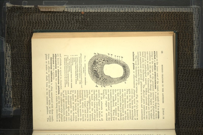 appear on the inner coat of the vessel, we speak of it as circum- scribed or nodose avterio-sclerosis. A certain degree of thick- ening of the intima of the peripheral arteries is a physiological condition in old age, and the change often begins to be appar- ent even in middle life. Circumscribed thickenings are however always of a pathological nature. Diffuse sclerosis may be com- bined with local thickenings. The affected parts sometimes ap- pear translucent and almost gelatinous in texture, and sometimes cartilaginous, or densely fibrous. The local thickenings of the intima (Fig. 37 efg}, known as sclerotic plates or atheromatous plaques, occur in arteries of every size, from the ascending aorta to the finest arterioles. They may be few in number or very numerous; and they are especially frequent in the aorta, where often it is difficult to find even a small area of the intima that remains en- tirely unaffected. When few in number, the sclerotic patches are usually situated near the point of origin of arterial branches. If the sclerosis is at all marked, plaques or tablets of an opaque yellowish-white or clear-white colour will always be found near the translu- cent, cartilaginous, or fibrous patches. These plates may be smooth or rough; and not in- frequently ulcers are formed beneath them by necrotic de- struction of the subjacent tis- sue, at the bottom of which lie masses of white detritus. Not infrequently the rough and ulcerated spots are cov- ered with thrombi, which may FIG. ATHEROMATOUS CEREBRAL ARTERY. (Preparation stained with haematoxylin, and mounted in Canada balsam : X 50) a intima considerably thickened 6 bounding elastic lamella of intima c media d adventitia e necrotic denucleated tissue with masses of fatty detritus /and fi detritus with cholesterin-plates g infiltrated leucocytes in the intima h infiltrated leucocytes in the adventitia be soft and translucent, thick and whitish, or mixed in character. The yellowish-white plaques are known as atheromatous patches, and the eroded spots as atheromatous ulcers, the process as a whole being described as atheroma of the arteries. Calcareous infiltration is often associated with these condi- tions, and affects especially the diseased spots, so that actual plates or scales of chalk form in the sclerotic patches. The
