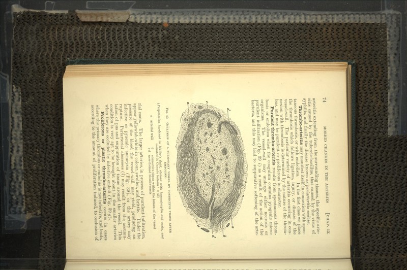 arteritis extending from the surrounding tissues, the specific arte- ritis caused by the tubercle-bacillus, that caused by the virus of syphilis, and finally the disease known as periarteritis nodosa. Thrombo-arteritis may manifest itself in connexion with spon- taneous thrombosis, or with embolism. In the first class we place the thrombosis which follows ligation, injury, or disease of the vessel-wall. The particular variety of arteritis occurring in con- nexion with thrombosis is determined by the nature of the throm- bus, and may be purulent or proliferous in character. Purulent thrombo-arteritis results from spontaneous throm- bosis or embolism when the coagulum contains pyogenic micro- organisms. The vessel-wall may undergo either necrosis or purulent infiltration (Fig. 39 i) as a result of the action of the bacteria, and this may lead to suppurative softening of the arte- FIG. 40. OCCLUSION OF A PULMONARY VESSEL BY CONNECTIVE TISSUE AFTER EMBOLISM. (Preparation hardened in Miiller's fluid, stained with haematoxylin and eosin, and mounted in Canada balsam: X 45) a arterial wall b connective tissue within the lumen of the vessel c d -new-formed blood-vessels rial coats. The larjaer arteries, in process of purulent infiltration, appear yellowish-white in colour, swollen, and brittle. Under the pressure of the blood the vessel-wall may yield, producing an infective or pyaemic aneurysm (Fig. 39), or the artery may rupture. Periarterial abscesses (i) may result from the accumu- lation of pus and suppuration of tissue around the vessel. This condition is very apt to be brought about in the smaller arteries when they are occluded by infective emboli (Fig. 39 g~). Proliferous or plastic thrombo-arteritis occurs in cases where the primary thrombus or embolus is not infective, and leads, according to the amount of proliferation induced, to occlusion of