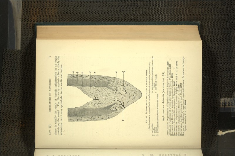 tissue is usually the result of chronic inflammation in an organ containing the vessel. The fibrous hyperplasia affects chiefly the adventitia, but it may spread also to the media and intima. FIG. 43. DIAGRAMMATIC SECTION OF A LIGATED VESSEL. (The thrombus is supposed to be entirely replaced by vascular fibrous tissue) adventitia dl new-formed fibrous tissue outside the media intima d new-formed fibrous tissue within the lumen lumen new blood-vessels References on Arteritis (see also Art. 18). APPOLLONIO : Organisation of ligation-thrombi Ziegler's Beitrdge in 1888 AUERBACH : Occlusion of arteries after ligation Inaug. Diss. Bonn 1877 BALLANCE and EDMUNDS : Ligation in continuity London 1891 BARBACCI : Acute aortitis verrucosa // Morgagni 189O BAUMGARTEN: Organisation d. Thrombus Leipzig 1877, and V. A. 78 1879 BUBNOFF : Organisation of thrombi V. A. 44 1868 BUCHWALD : Aortitis verrucosa D. med. Woch. 1878 BURDACH : Senftleben's experiment (connective-tissue formation in doubly- ligated vessels) V. A. 100 1885