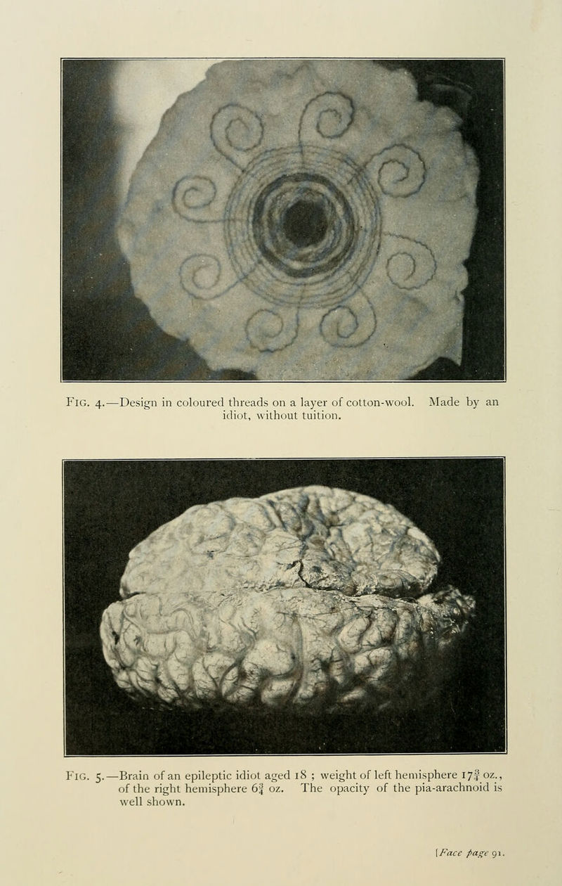 Fig. 4.—Design in coloured threads on a layer of cotton-wool. Made by an idiot, without tuition. Fig. 5.—Brain of an epileptic idiot aged 18 ; weight of left hemisphere lyf oz., of the right hemisphere 64 oz. The opacity of the pia-arachnoid is well shown. {Face page 91.