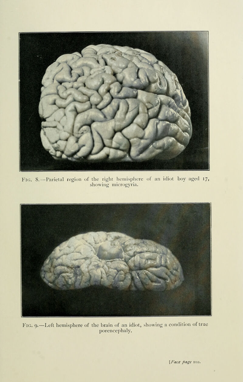 showing microgyria. Fig. 9.—Left hemisphere of the brain of an idiot, showing a condition of true porencephaly.