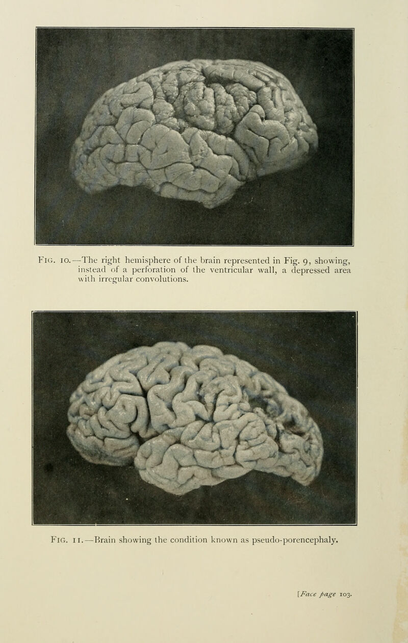 instead of a perforation of the ventricular wall, a depressed area with irregular convolutions. Fig. II.—Brain showing the condition known as pseudo-porencephaly.