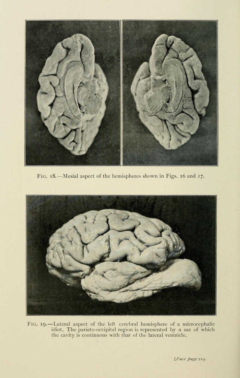 Fig. 18.—Mesial aspect of the hemispheres shown in Figs. i6 and ij. ■1 \ ' f -. ^^B /- ^^^K ■ J V \ *«^J^^^H ^^^^^B r ^ ^^ J ^^^^H HHJC j:^ ^p ^^^^^^^H ^^H 1 Fig. 19. — Lateral aspect of the left cerebral hemisphere of a microcephalic idiot. The parieto-occipital region is represented by a sac of which the cavity is continuous with that of the lateral ventricle.